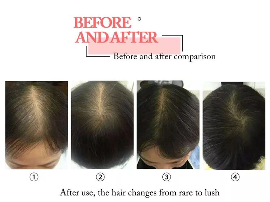 Laser Hair Regrowth Beauty Equipment Anti Hair Loss Treatment