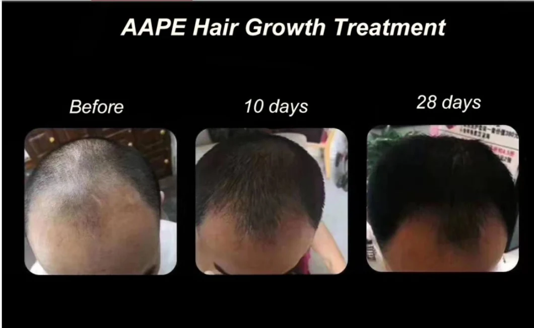 Aape Efficient Hair Growth Stem Cell Women Men Regrowth Factors Anti Hair Loss Care Treatment for Hair-Loss Prevention, Hair-Repairing and Skin Anti-Wrinkle