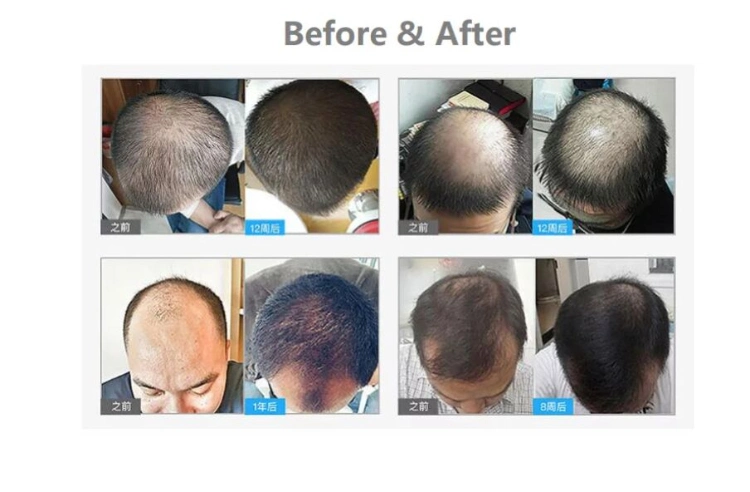 Lllt 650nm Laser Diode Hair Growth Cap for Hair Loss Treatment